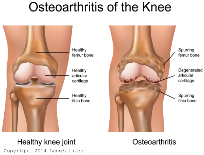 Arthritis Knee Pain Back Pain Cervical Spondylosis